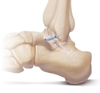 Arthrex- Cabinet médical Dr Maxime Pilloud