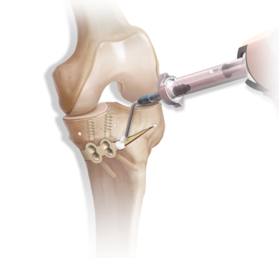 Arthrex- Cabinet médical Dr Maxime Pilloud