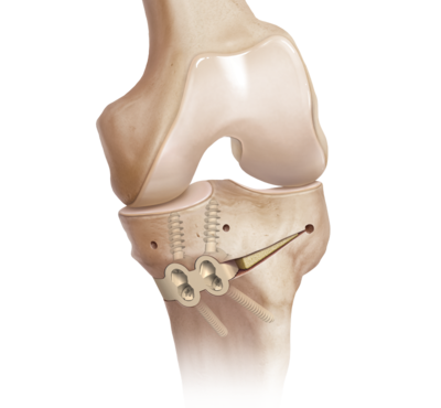 Arthrex- Cabinet médical Dr Maxime Pilloud