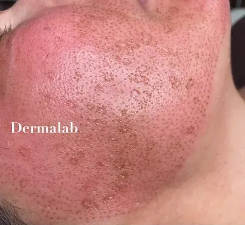 Un primer plano de la cara de una persona con muchas pecas.