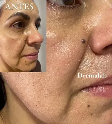 Una fotografía de antes y después del rostro de una mujer.