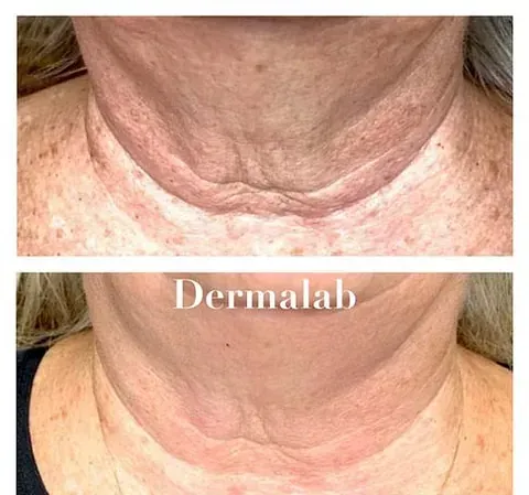 Una foto de antes y después del cuello de una mujer con arrugas.