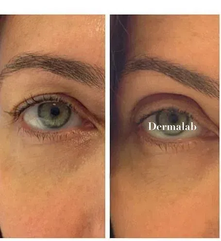 Una fotografía de antes y después de los ojos de una mujer.