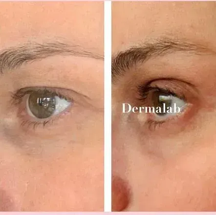 Una fotografía de antes y después del ojo de una mujer.