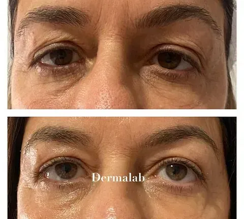 Una fotografía de antes y después de los ojos de una mujer.