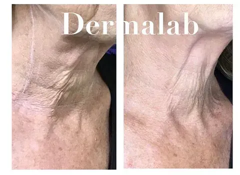 Una fotografía de antes y después del cuello y el pecho de una mujer.