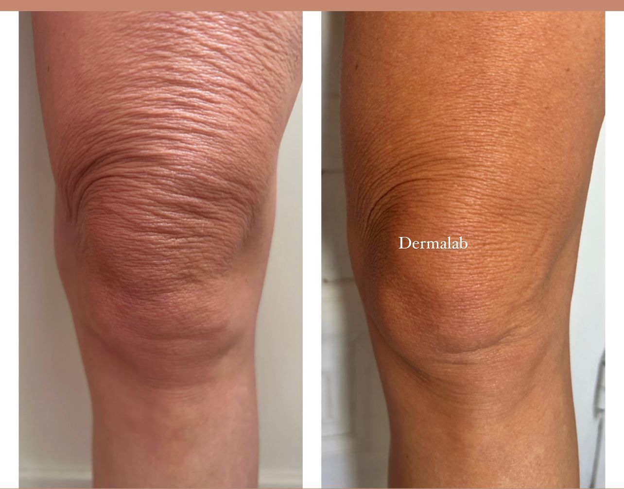 Una foto de antes y después de la rodilla de una mujer.