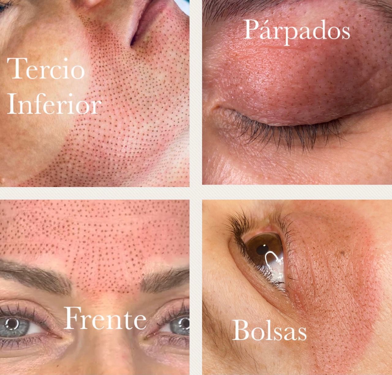 Cuatro imágenes del rostro de una mujer con las palabras tercio inferior parpado frente y bolsas