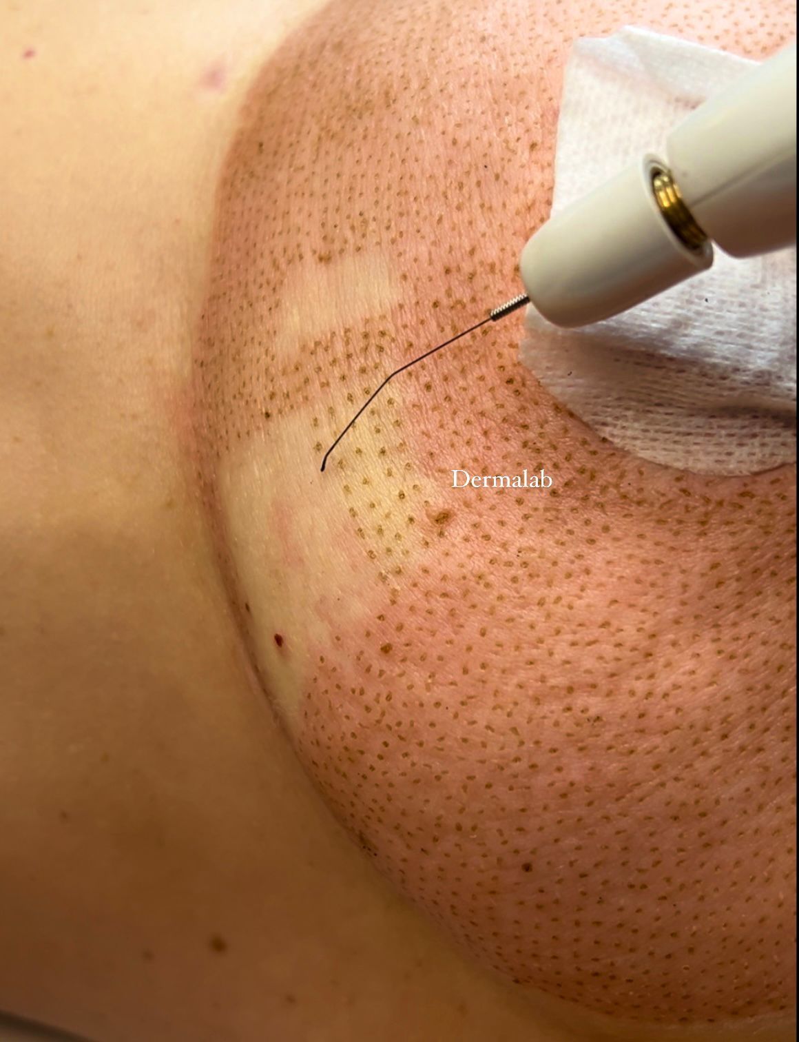 Un primer plano de una persona que recibe una aguja en la piel.