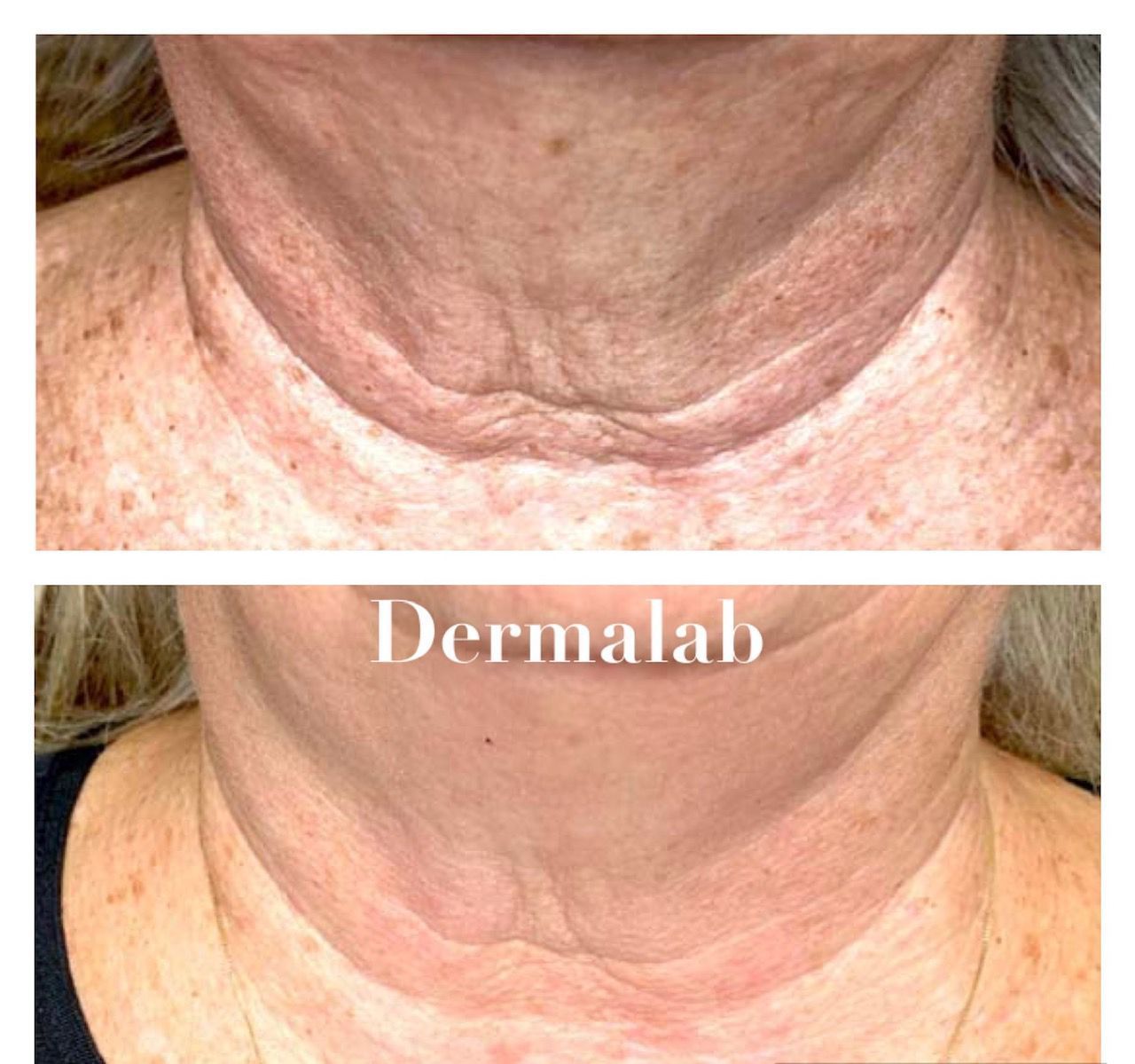 Una foto de antes y después del cuello y escote de una mujer.