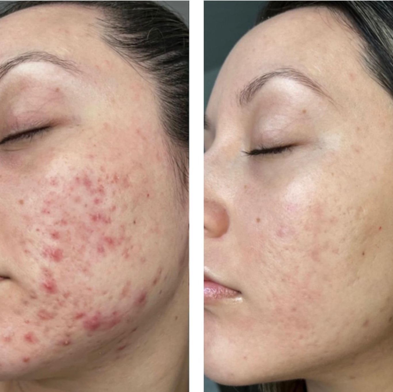 Una fotografía de antes y después del rostro de una mujer con acné.