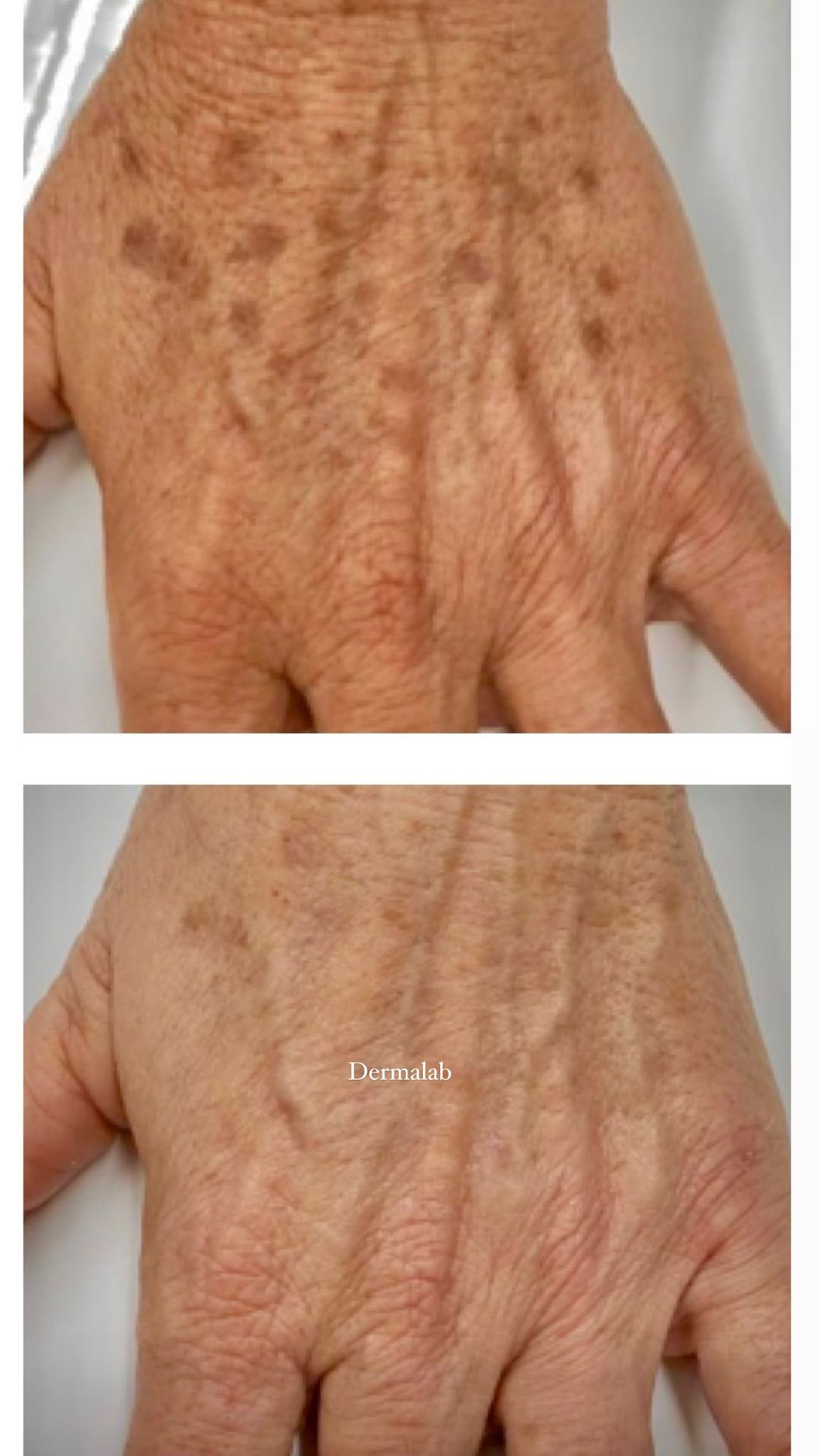 Una fotografía de antes y después de la mano de una persona con manchas.