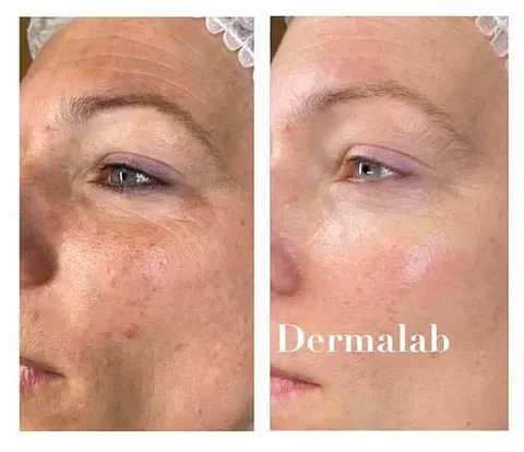 Una fotografía de antes y después del rostro de una mujer.