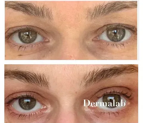 Una fotografía de antes y después de los ojos de una mujer.