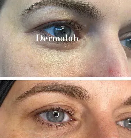 Una fotografía de antes y después del ojo de una mujer.