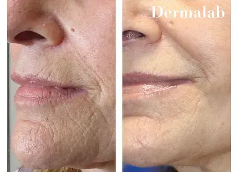 Una fotografía de antes y después de la cara de una mujer con arrugas.