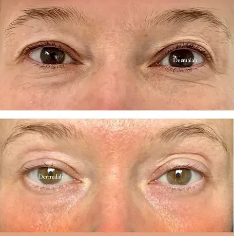 Una fotografía de antes y después de los ojos de una mujer.