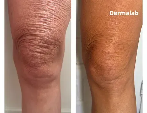 Una fotografía de antes y después de la rodilla de una mujer.