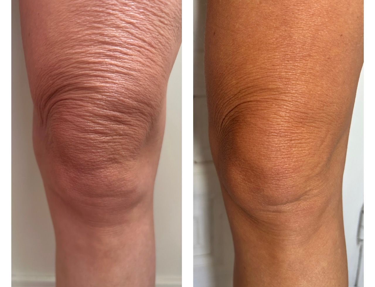 Una fotografía de antes y después de la rodilla de una mujer.