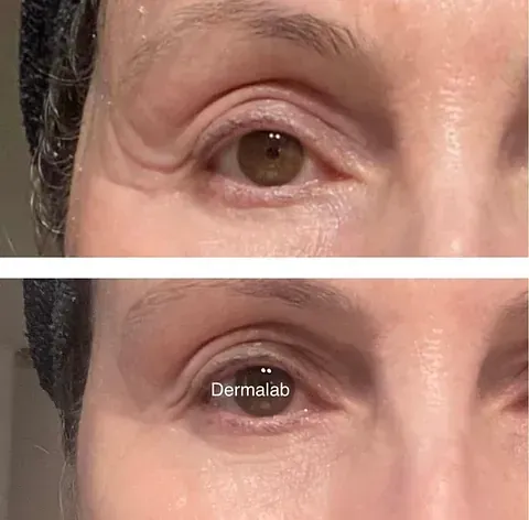 Una fotografía de antes y después del ojo de una mujer.