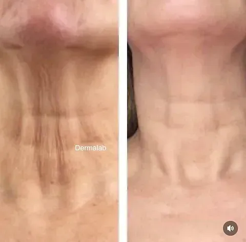 Una fotografía de antes y después del cuello y el pecho de una mujer.