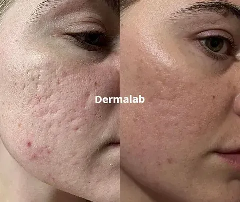 Una fotografía de antes y después de la cara de una mujer con acné.