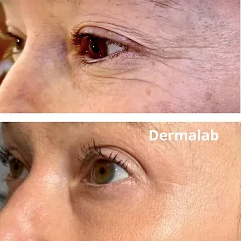 Una fotografía de antes y después del ojo de una mujer.