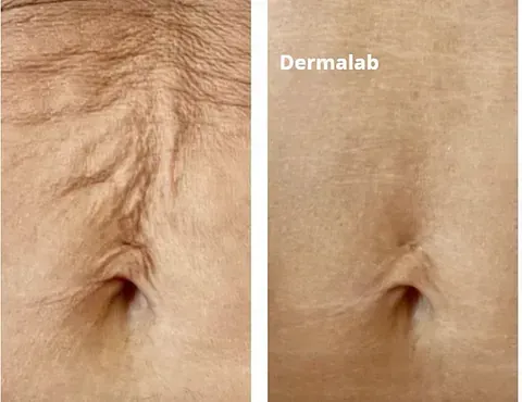 Una fotografía de antes y después del vientre de una mujer.