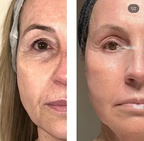 Una fotografía de antes y después del rostro de una mujer.