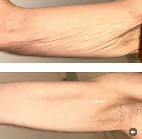Una foto de antes y después del brazo de una mujer.