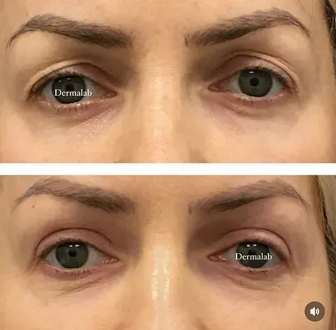 Una fotografía de antes y después de los ojos de una mujer.