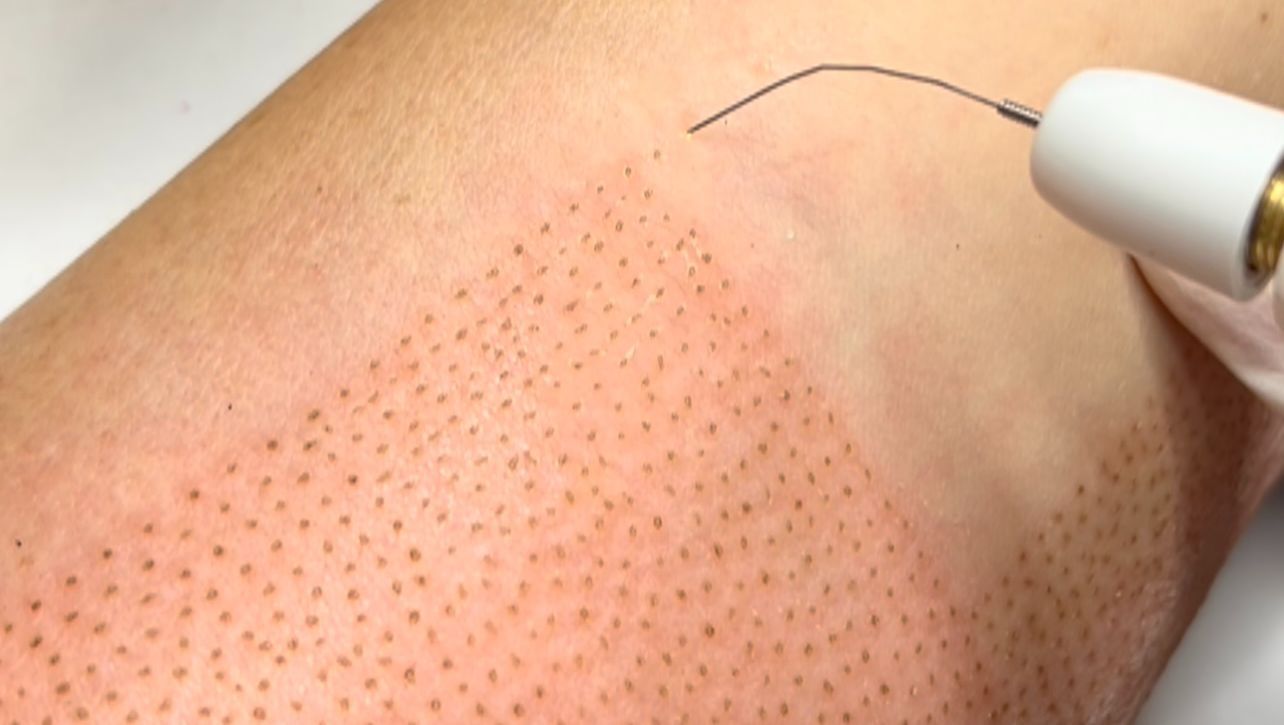 Un primer plano del brazo de una persona con un dispositivo en él.