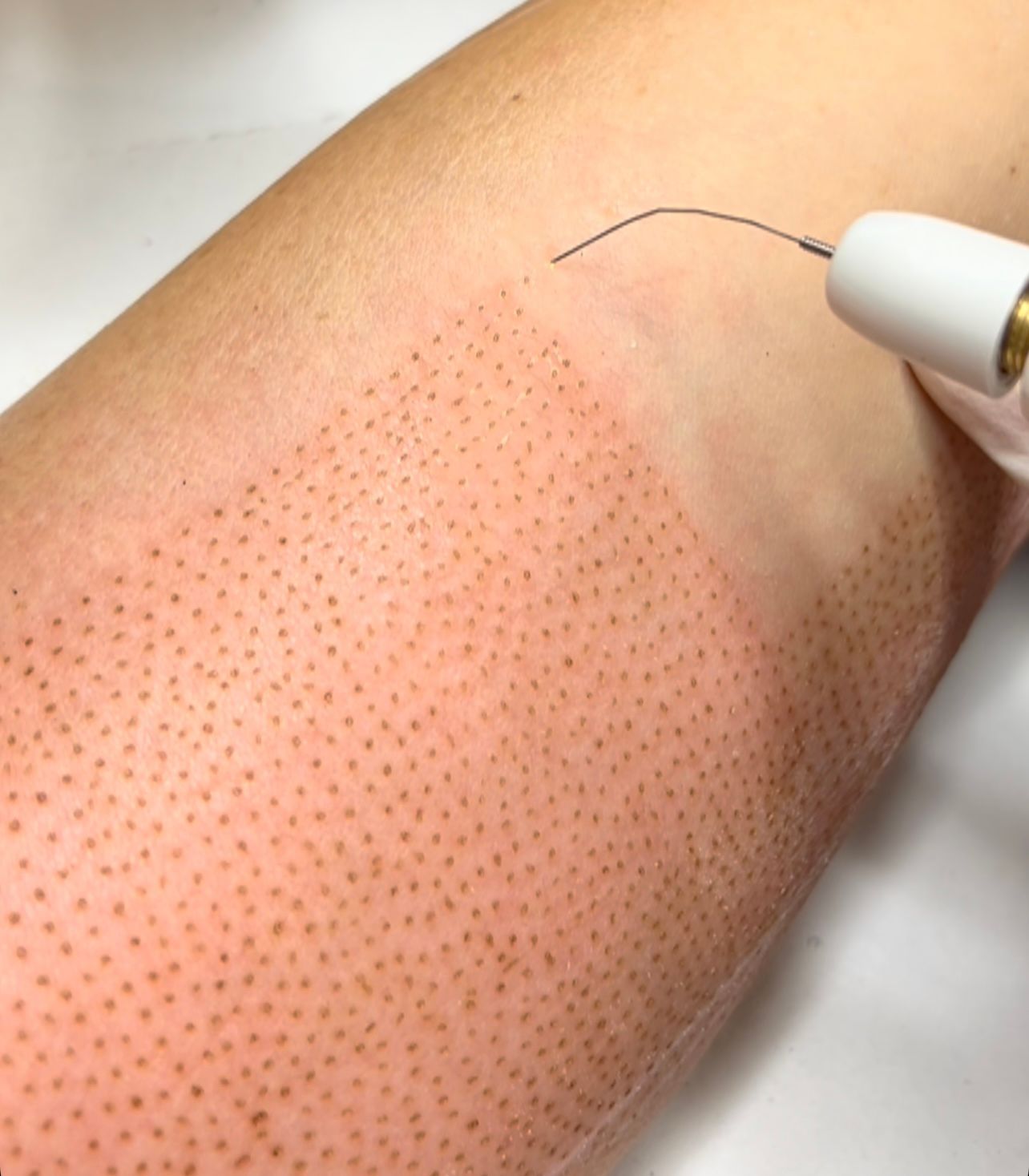 Un primer plano del brazo de una persona con una jeringa dentro.