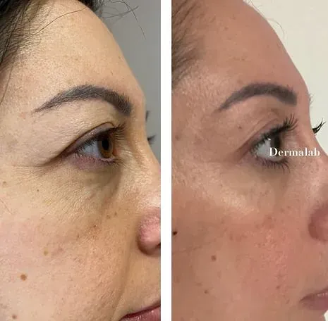 Una fotografía de antes y después del rostro de una mujer.