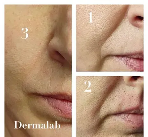 Se muestra el rostro de una mujer antes y después de un tratamiento.