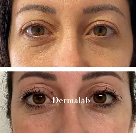 Una fotografía de antes y después de los ojos de una mujer.