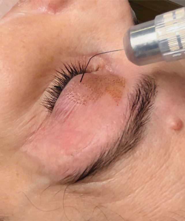 Un primer plano del ojo de una mujer con una aguja en él.