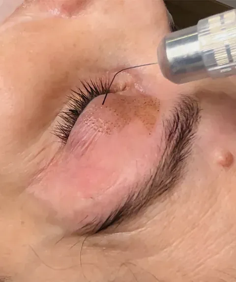 Un primer plano del ojo de una mujer con una aguja en él.