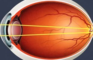 Un diagrama de un ojo humano con una línea amarilla que lo atraviesa.