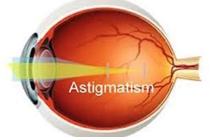 Un diagrama de un ojo humano que muestra astigmatismo.