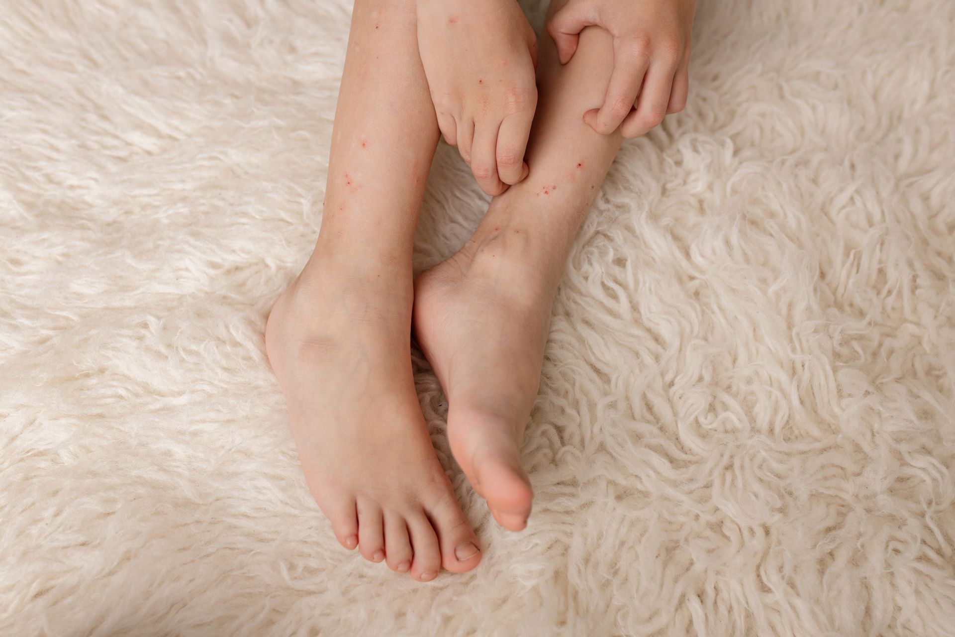 Jambes d'enfants piquées par des punaises de lit