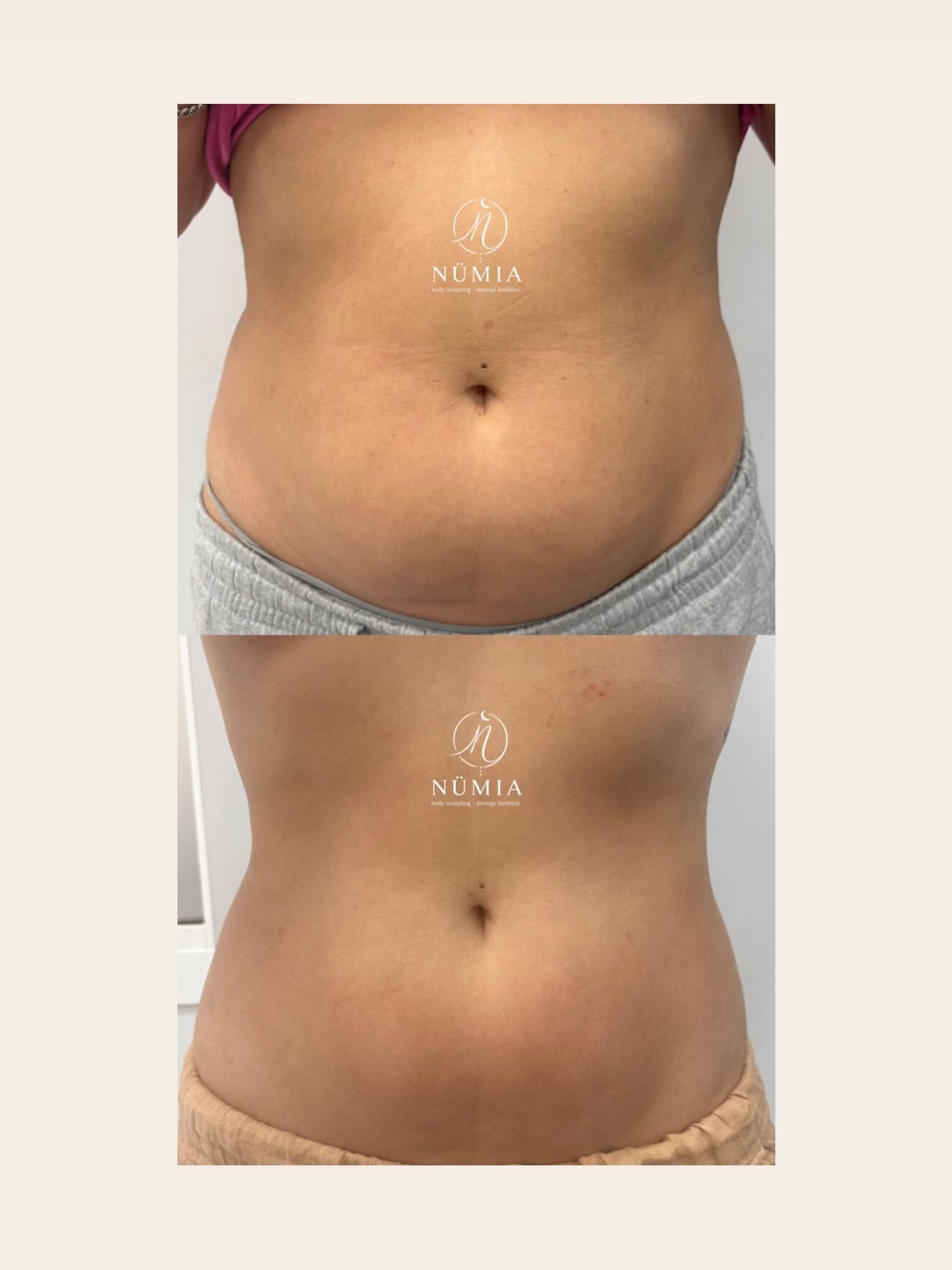Comparación del torso de frente y de perfil que muestra el contorno abdominal con ropa interior gris y pantalones beige.