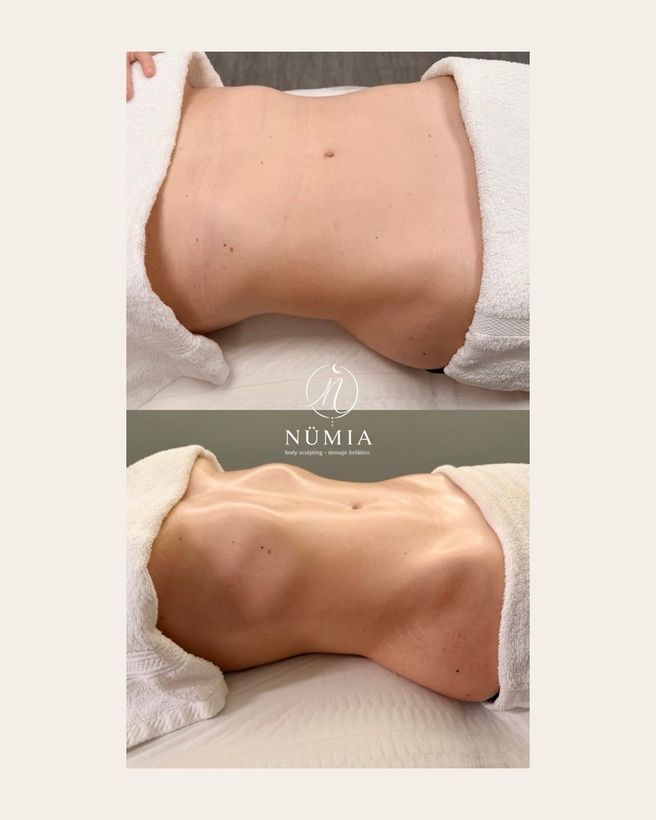 Fotografías comparativas del torso que muestran una cintura más delgada después del tratamiento, sobre un fondo neutro.