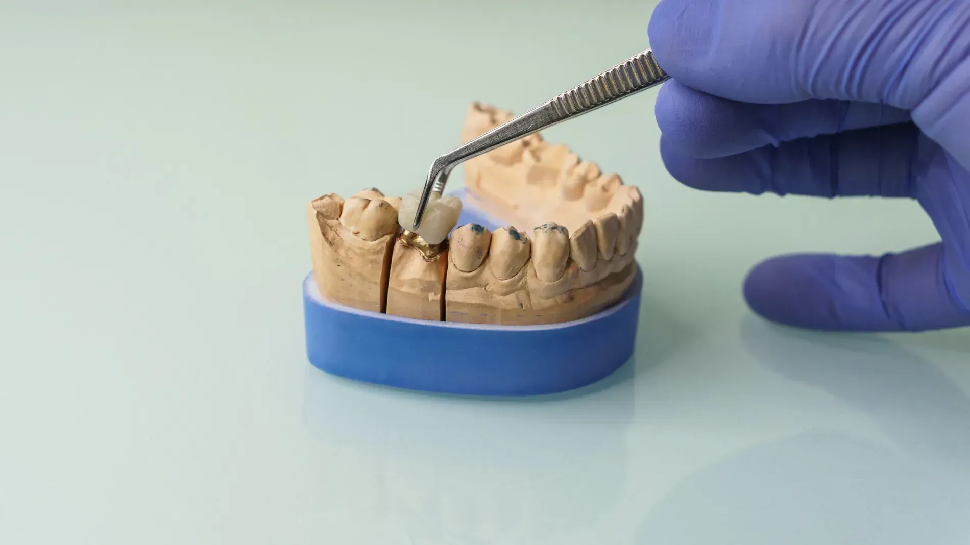 Una mano enguantada en un guante azul que sostiene unas pinzas coloca una corona dental sobre un modelo de yeso de los dientes.