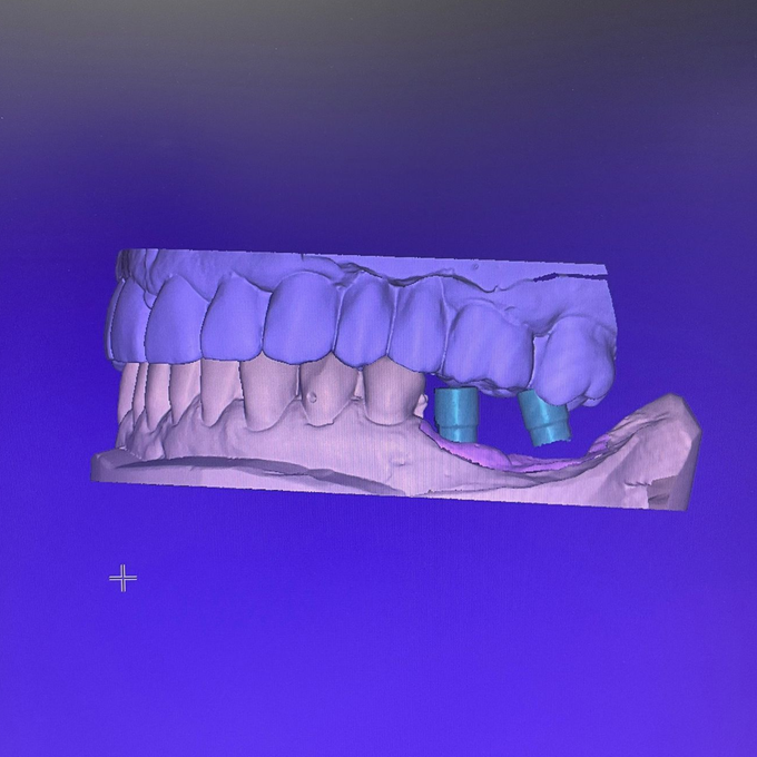 Modelo digital de dientes, con coloración azul y violeta, que muestra implantes dentales.