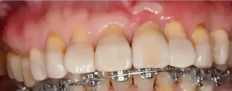 Primer plano de dientes con brackets. Los dientes están amarillos y las encías inflamadas.