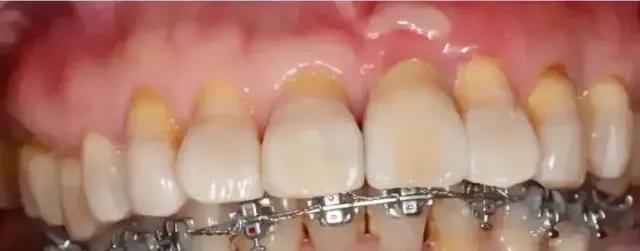 Primer plano de dientes con brackets. Los dientes están amarillos y las encías inflamadas.