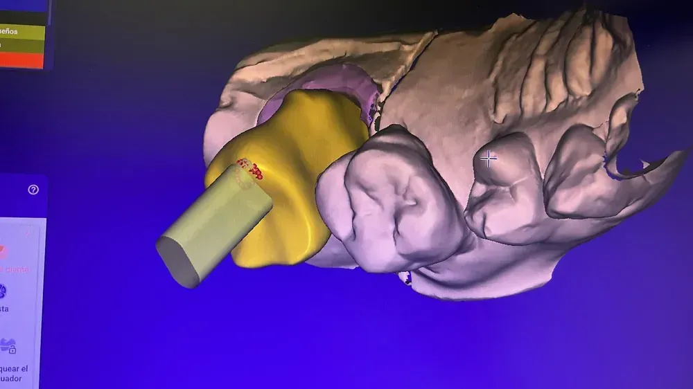 Escaneado de diente sobre implante
