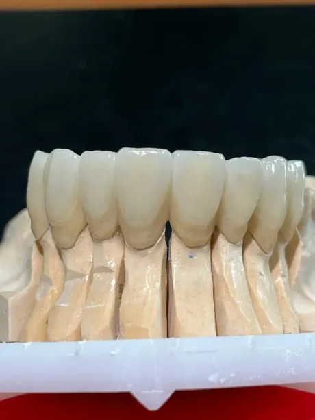Puente dental sobre un modelo, mostrando múltiples dientes artificiales.
