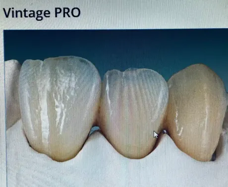 Primer plano de tres coronas dentales en fila, con tonos de blanco y beige, ilustrando los dientes.